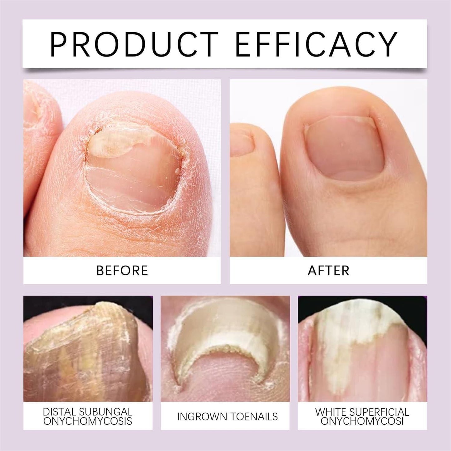 Fungi Free Bee Venom Nail Treatment Solution Serum (Buy 1 Get 1 Free)